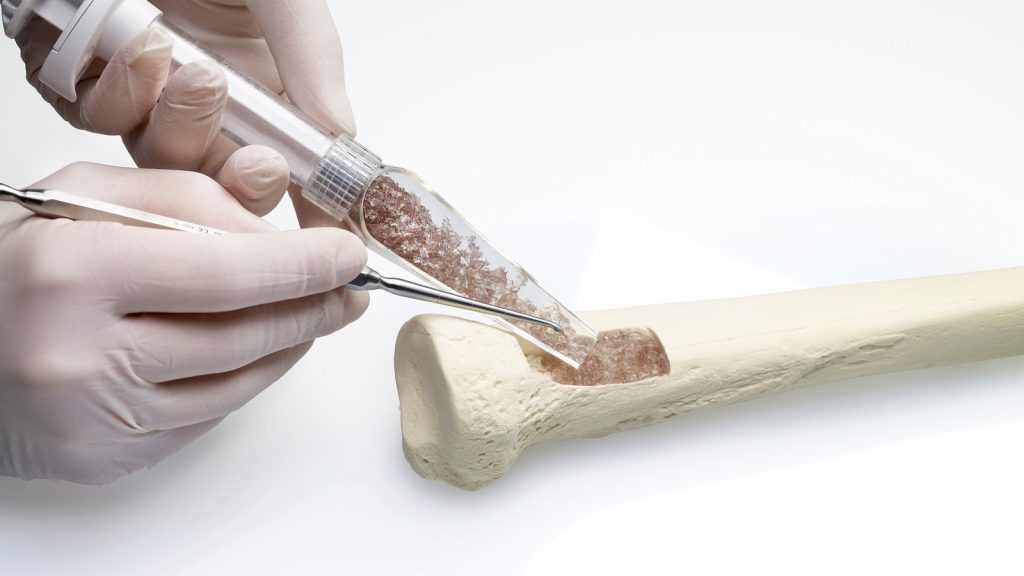 Ученые нашли «переключатель» роста костей для нового лекарства от остеопороза