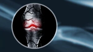x ray cracked broken bones