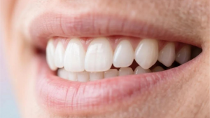 Виниры и отбеливание: почему белоснежная улыбка не гарантирует здоровья зубов